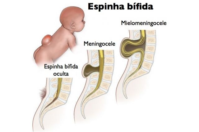 o que é espinha bifida