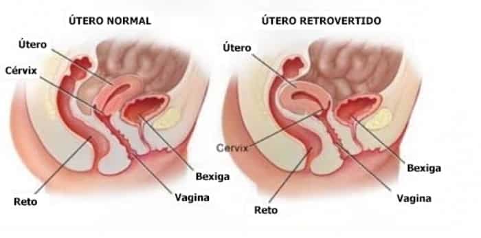 causas do utero retrovertido