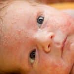 Brotoejas em Bebês: tratamentos caseiros, remédios, como evitar