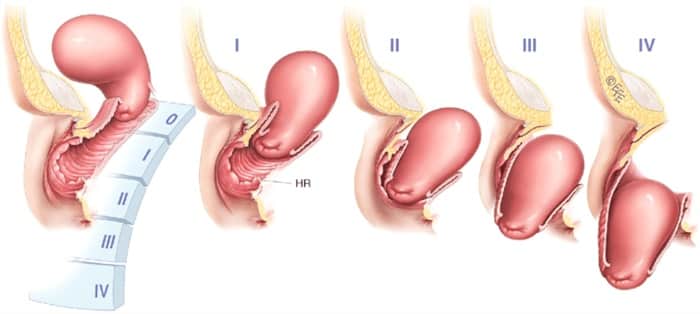 prolapso uterino