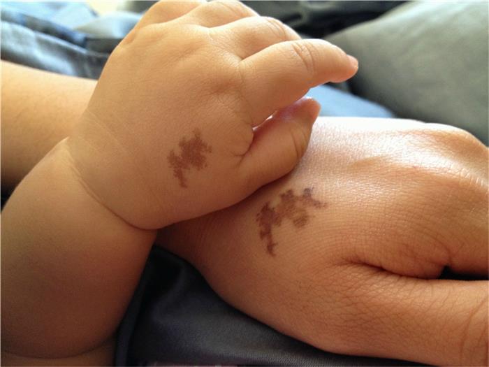 tatuagem marca de nascença