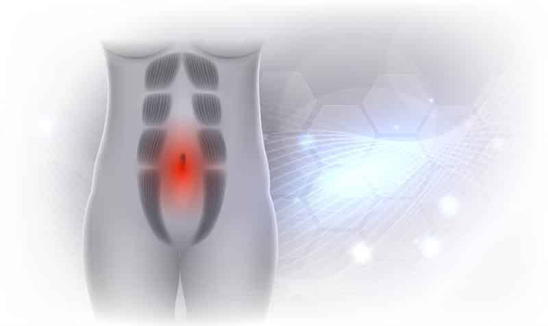 diástase abdominal